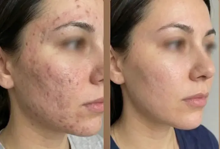 Antes e depois de cicatrizes de acne com laser CO2