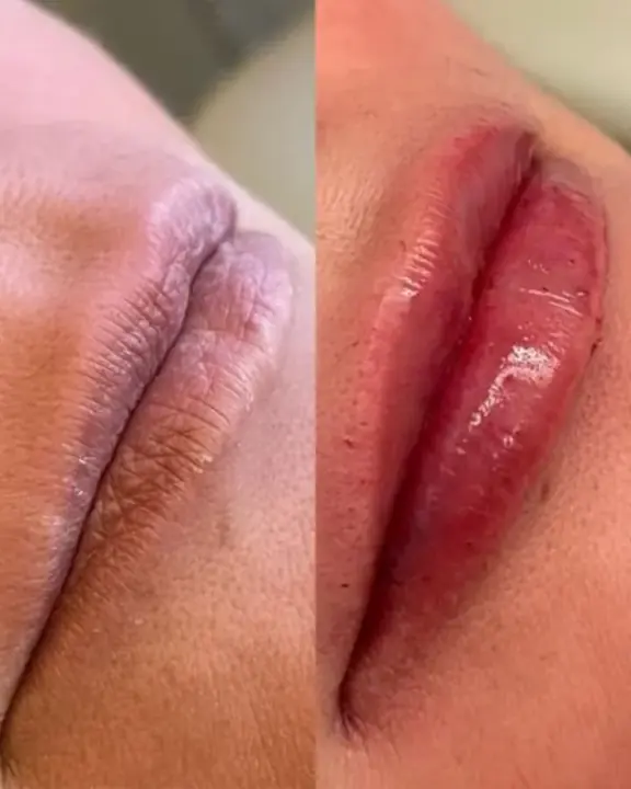 Antes e depois de lábios