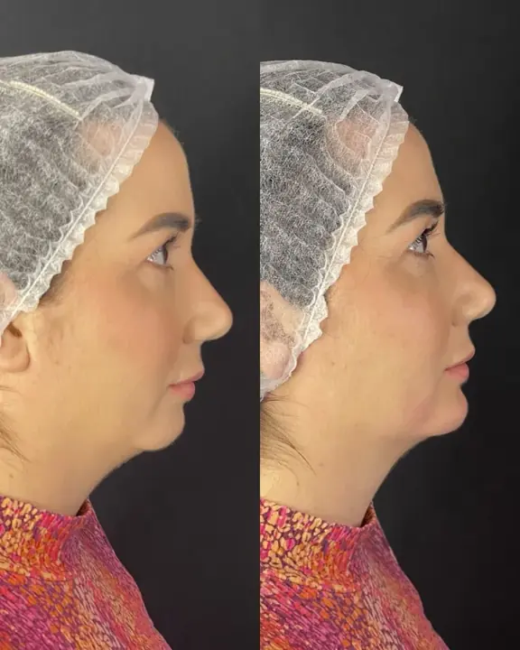 Antes e depois de perfil e queixo