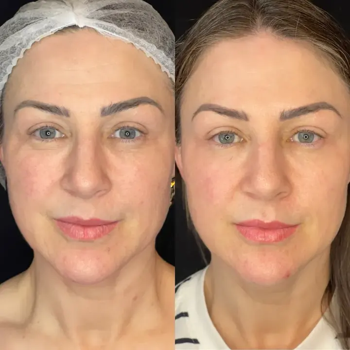 Antes e depois de rosto
