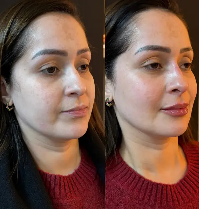 Antes e depois de rosto