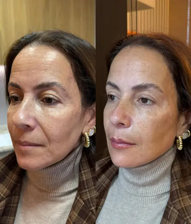 Antes e depois de rosto